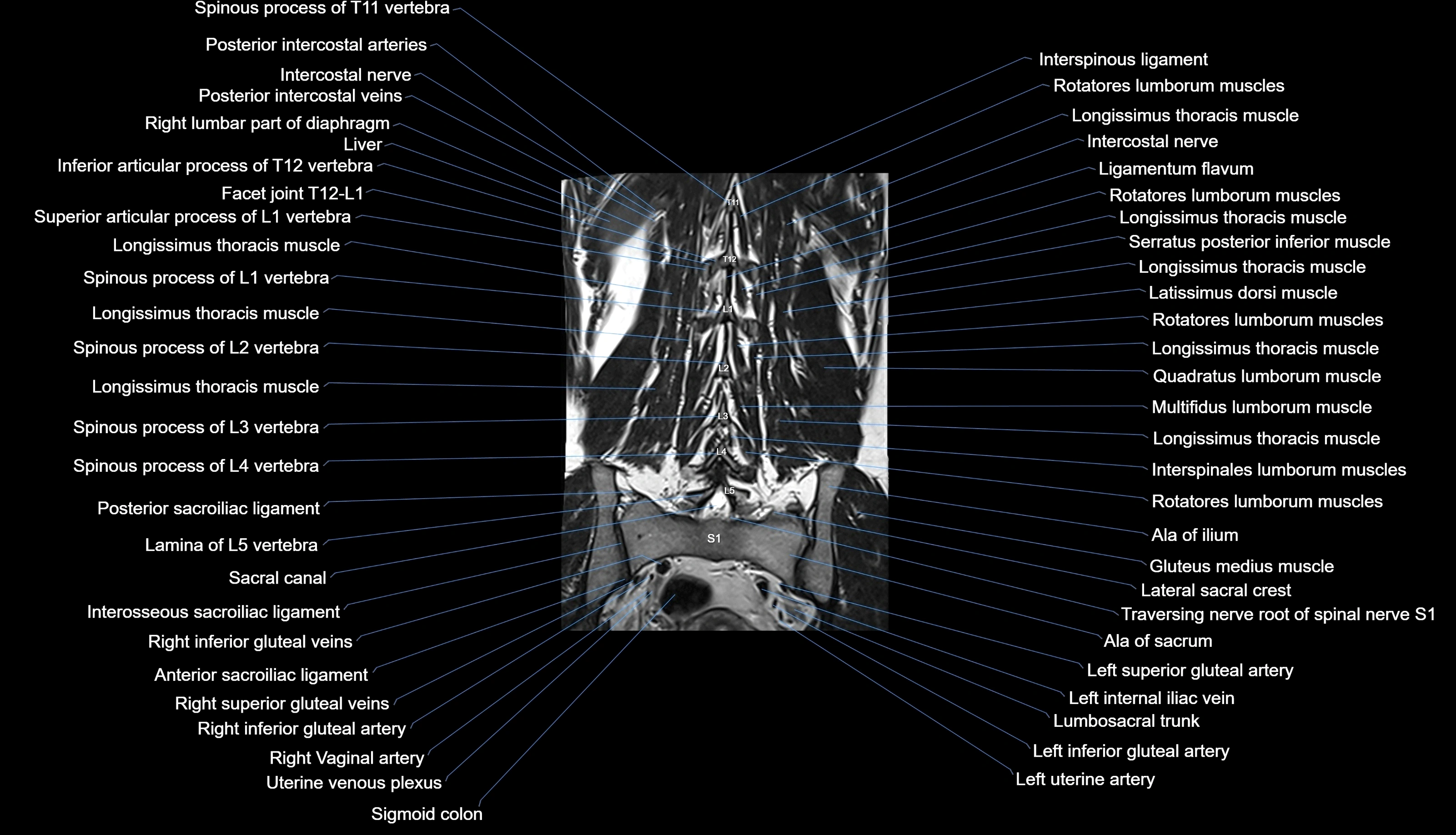 MRI lumbar spine labelled coronal cross sectional anatomy 3T radiology-img-00001-00025.webp